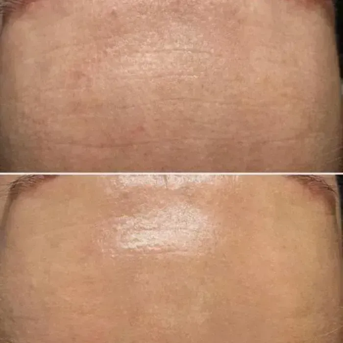 Avant et après Microneedling, front