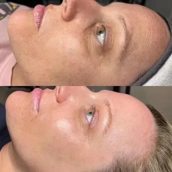 Avant et après Microneedling, profil