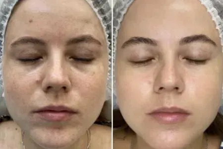 Avant et après Microneedling, visage